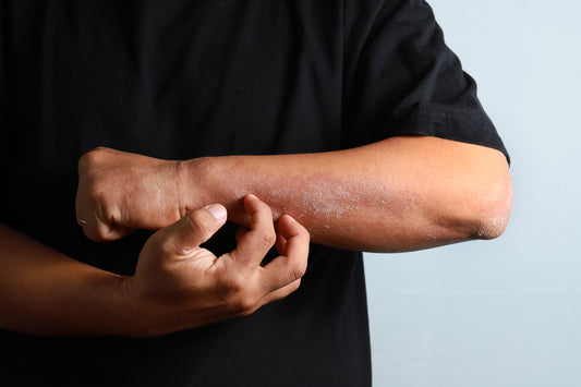Como o ômega 6 pode minimizar a dermatite atópica
